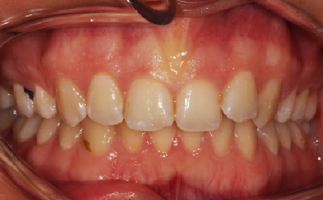 Bonding and Gum Recontouring - Apolline Dental | Dentist in Chingford